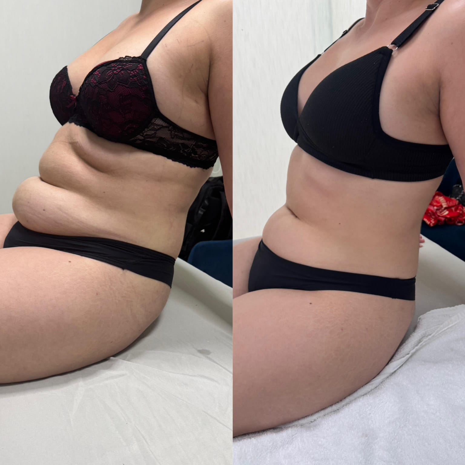 Resultado de procedimento estético - Clínica Lamurie