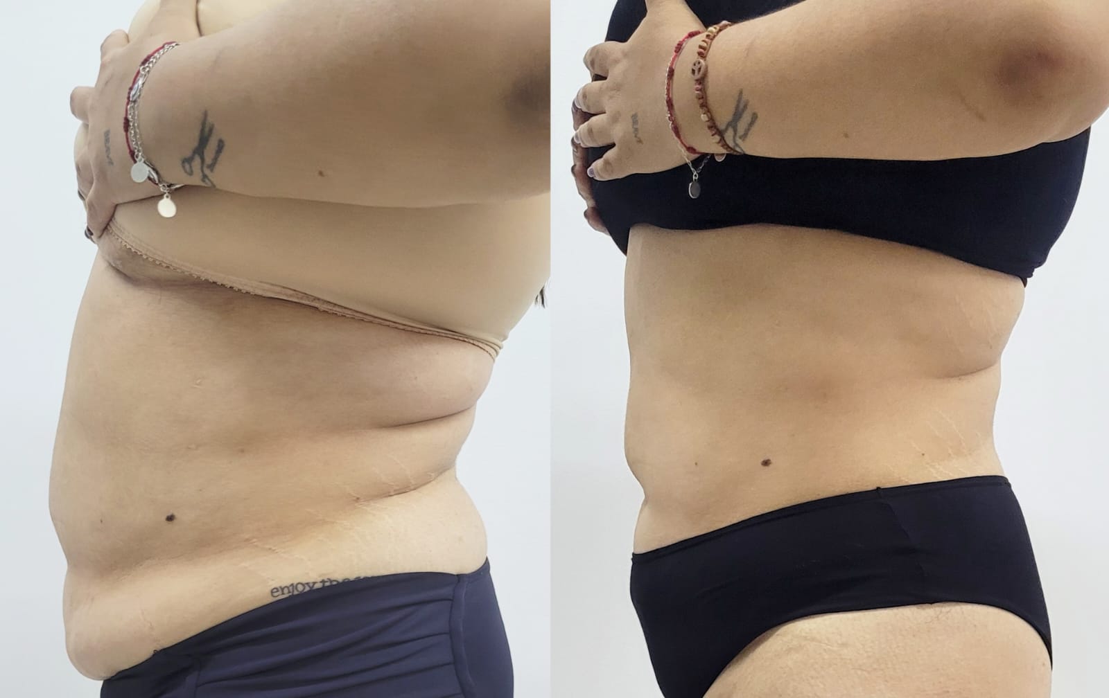 Resultado de procedimento estético - Clínica Lamurie