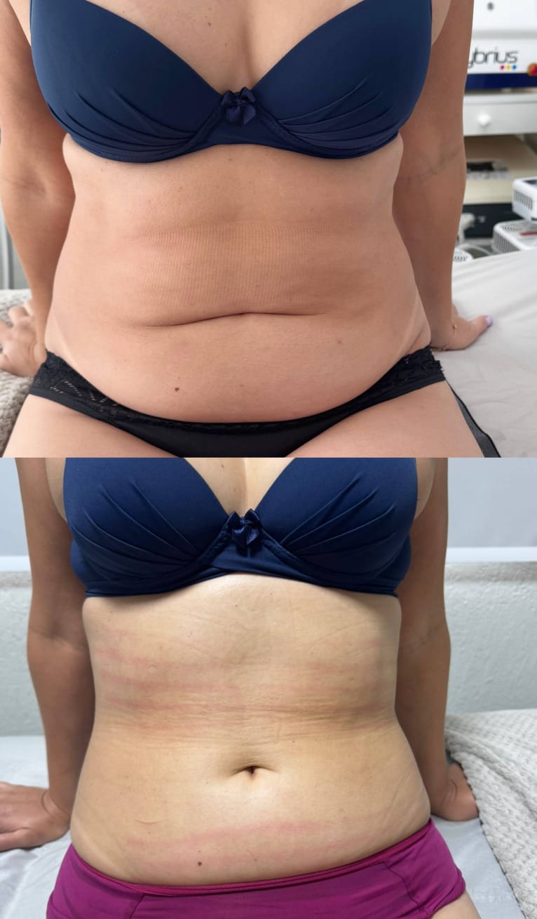 Resultado de procedimento estético - Clínica Lamurie