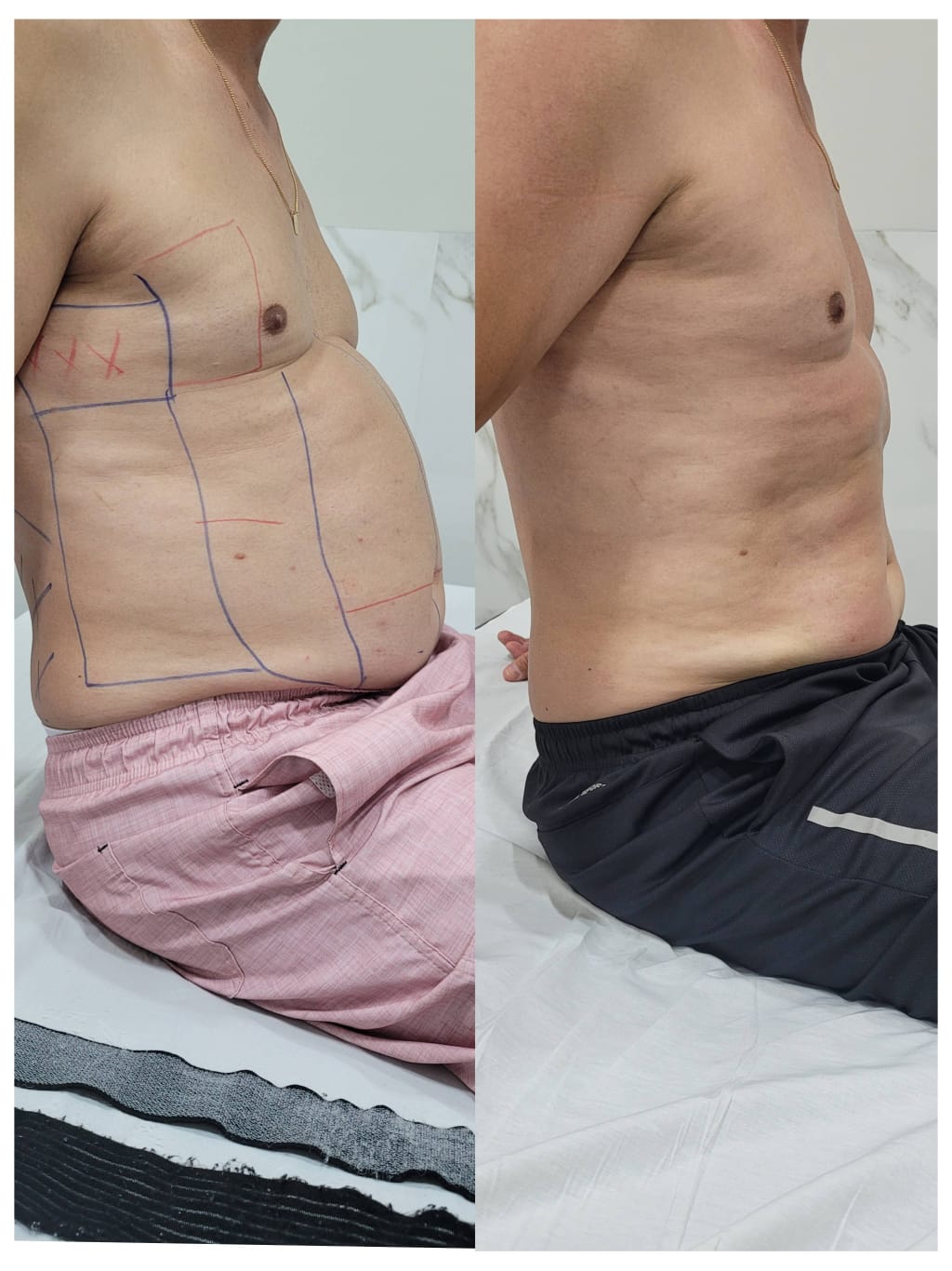 Resultado de procedimento estético - Clínica Lamurie