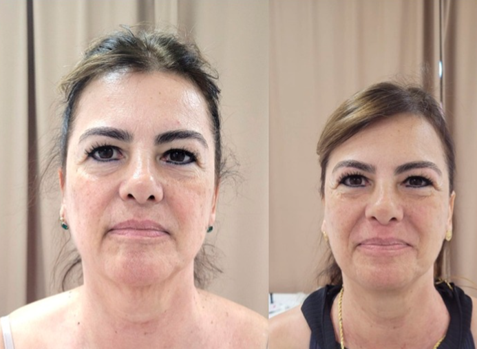 Resultado de harmonização facial - Clínica Lamurie