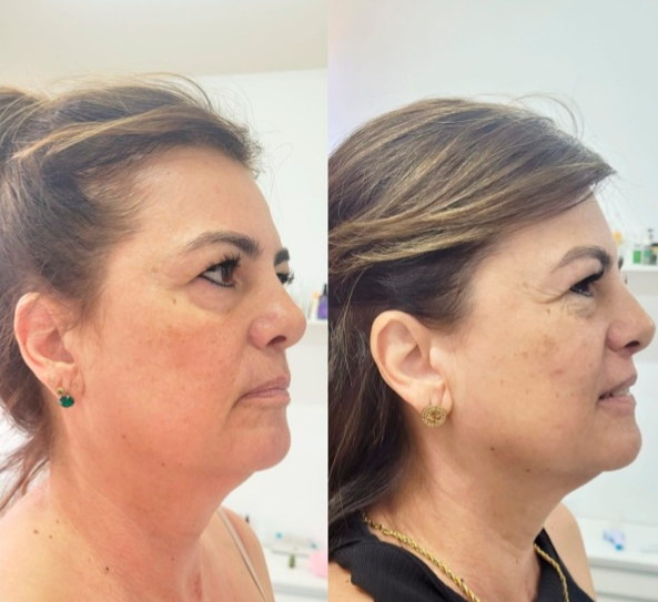 Resultado de harmonização facial - Clínica Lamurie